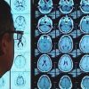 Cuba vai testar em humanos medicamento que combate o Alzheimer cuba-medicamento-combate-alzheimer